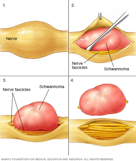 Schwannoma (u bao sợi thần kinh): Chẩn đoán và điều trị