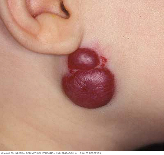 U máu (hemangioma): triệu chứng và điều trị