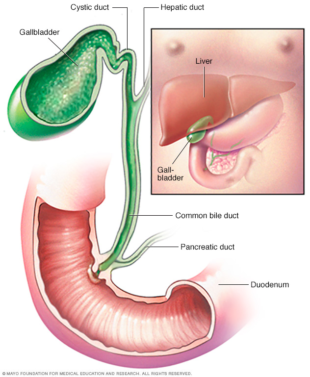 Ung thư đường mật rốn gan (hilar cholangiocarcinoma)