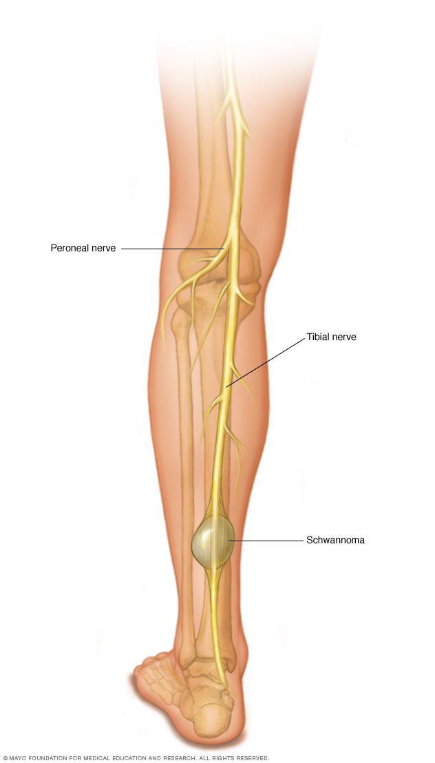 Schwannoma ở chân