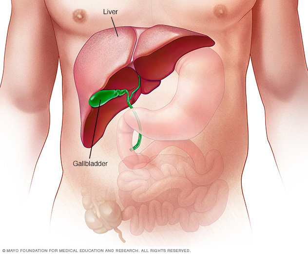 Bệnh thừa sắt (hemochromatosis): triệu chứng và điều trị