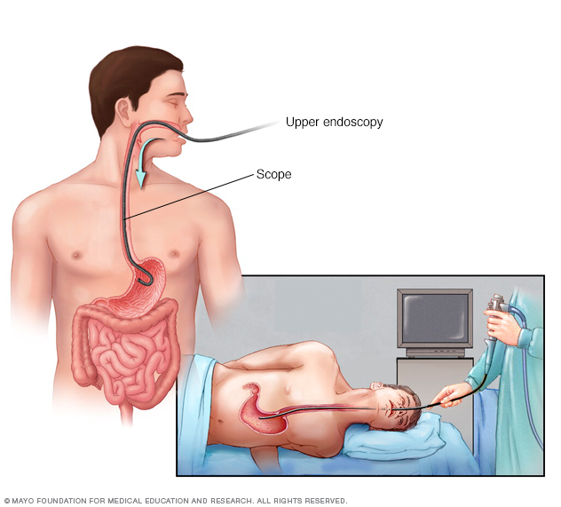 Nội soi đường tiêu hóa trên