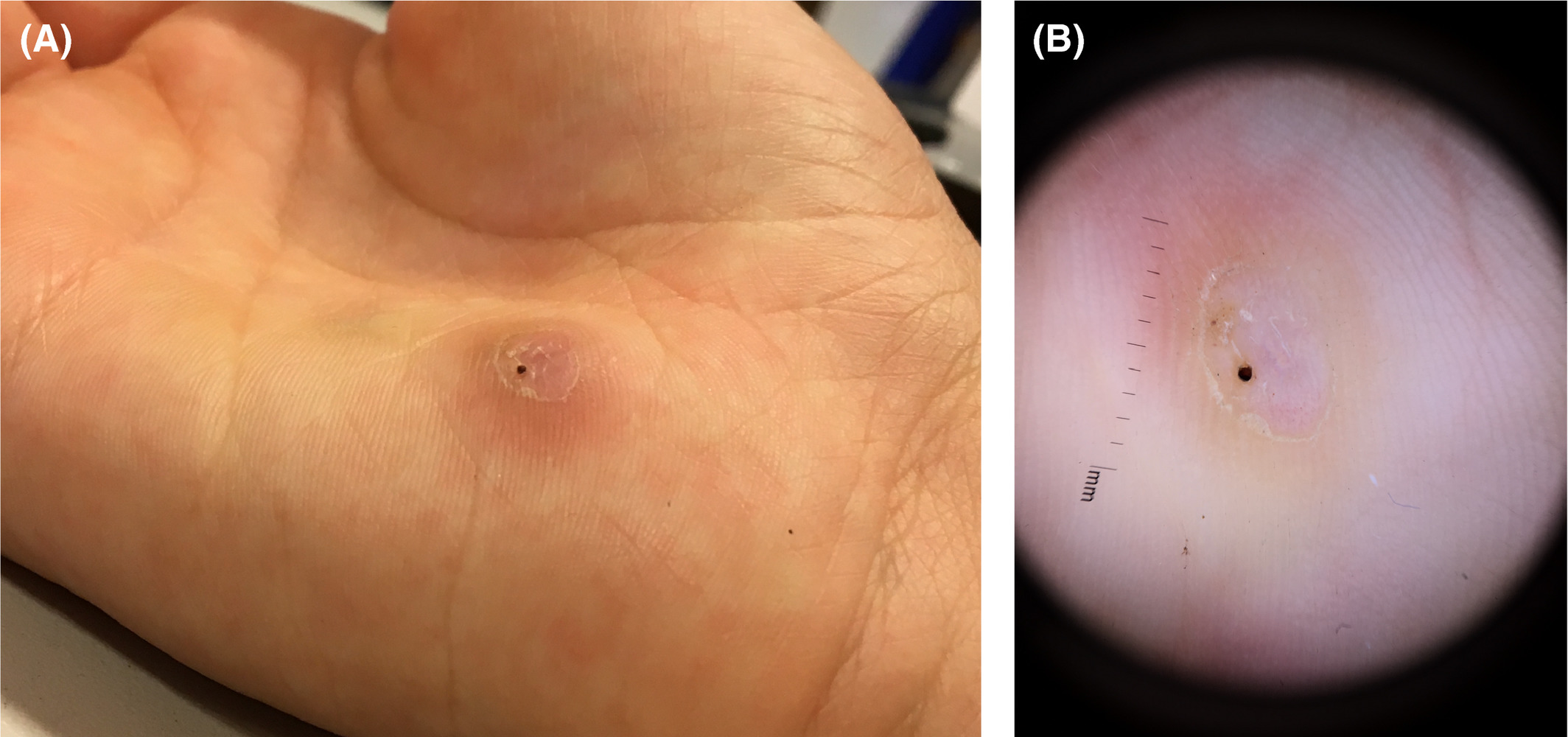 Sarcoma biểu mô (epithelioid sarcoma)