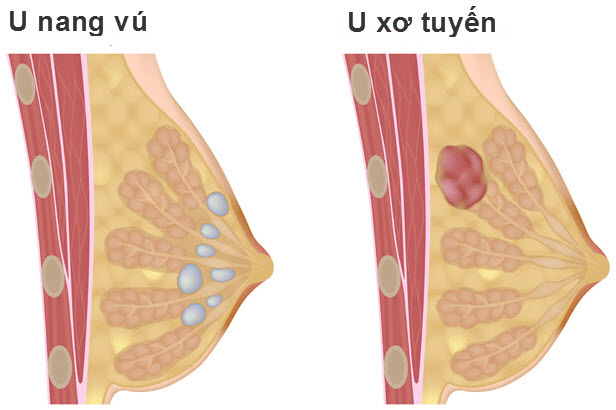 Những nguyên nhân gây ra cục u ở vú