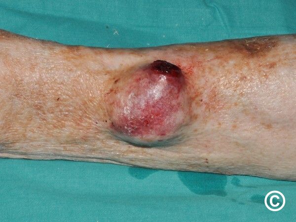 Leiomyosarcoma (ung thư mô cơ trơn) là gì?