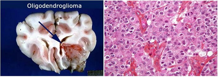 U nguyên bào thần kinh đệm ít nhánh (oligodendroglioma)