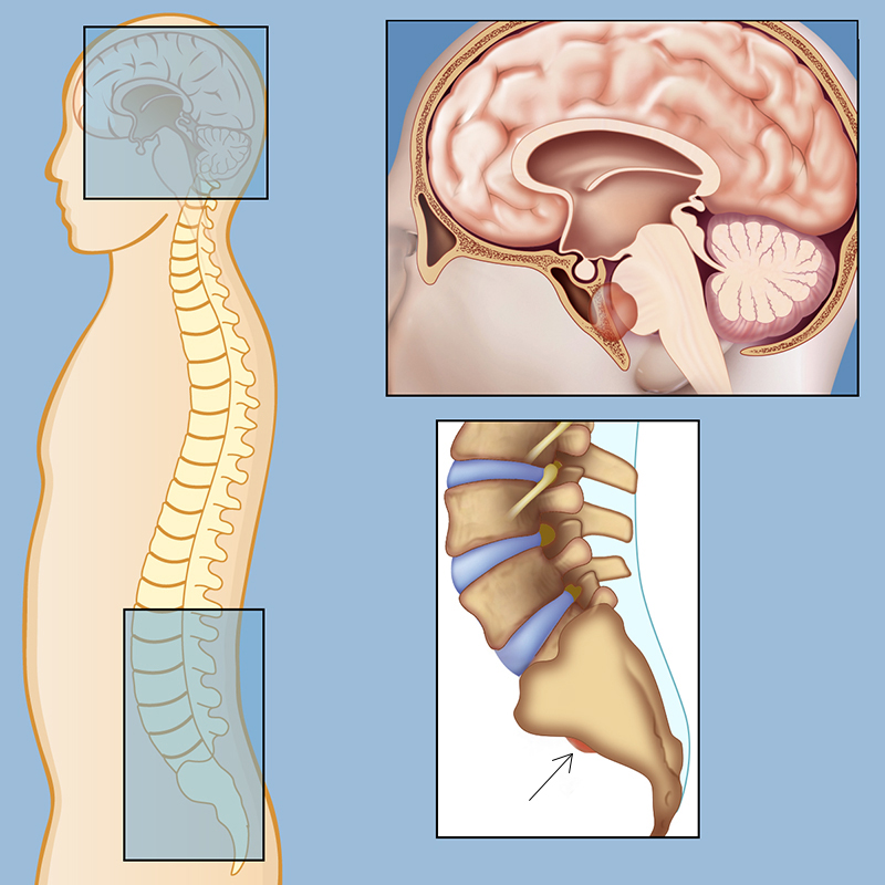 U nguyên sống (chordoma): chẩn đoán và điều trị