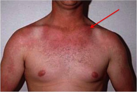 Hội chứng carcinoid: triệu chứng, nguyên nhân và điều trị