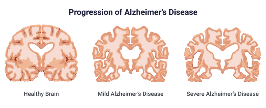 Công cụ AI dự đoán tiến triển của bệnh Alzheimer chính xác hơn các xét nghiệm